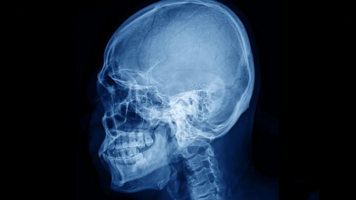 Ученые улучшили "оптическое просветление" тканей черепа